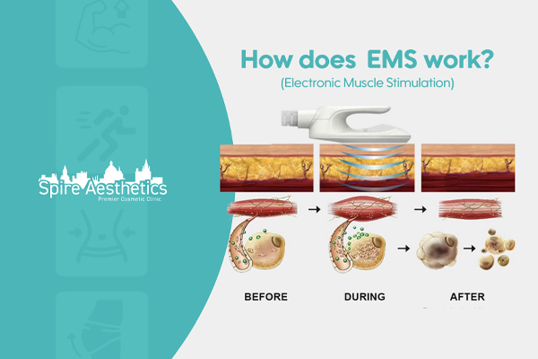 EMS treatment for post pregnancy weight loss treatment Bishopbriggs