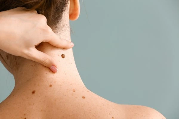 skin blemish removal Bishopbriggs treatment